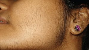 kadinlarda_asiri_tuylenmeye_neden_olan_5_hastalik_1502717768_2606